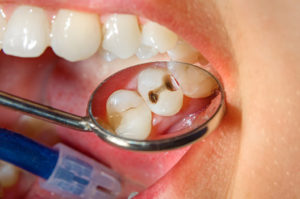 dental cavity
