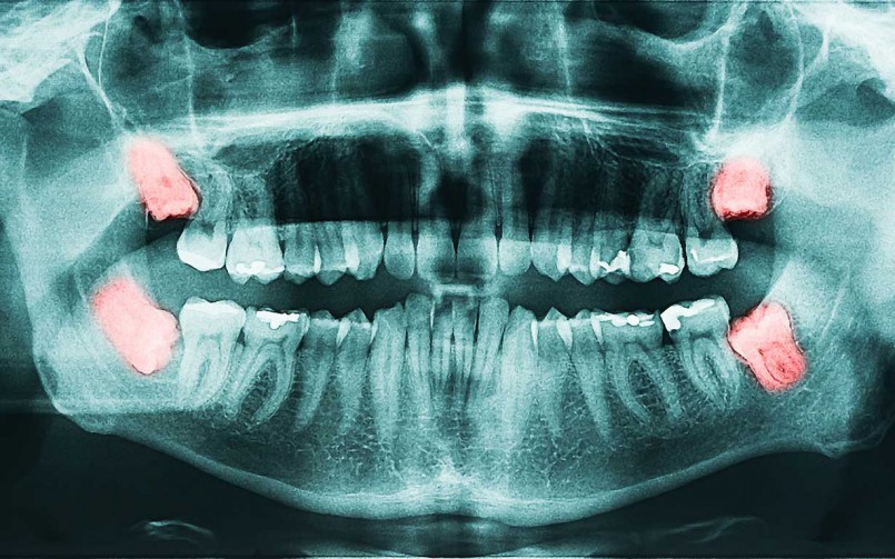 wisdom tooth extraction dr joy dental clinic dubai