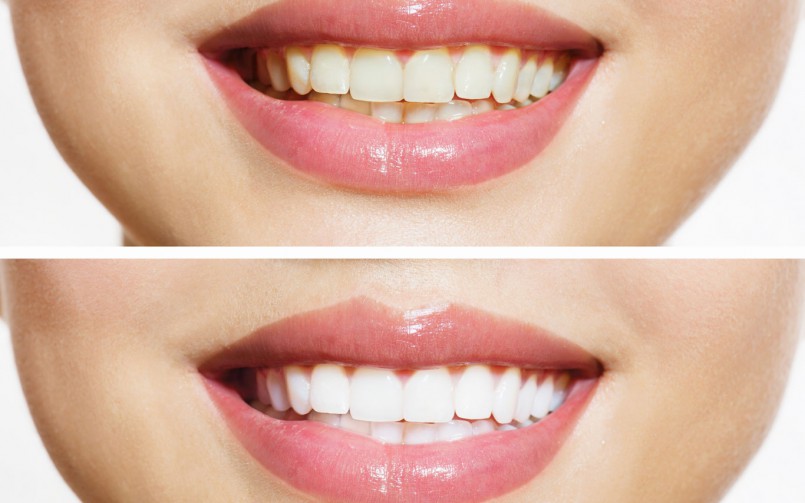 Instant teeth whitening