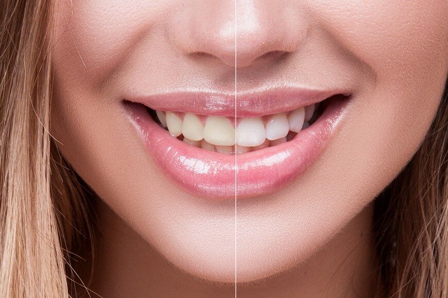 teeth whitening procedure