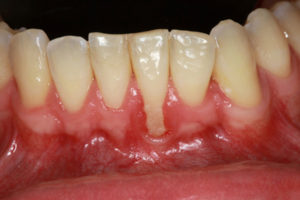 before gum treatment