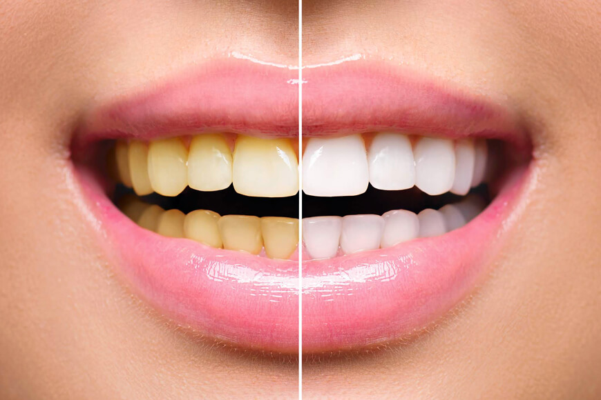 Laser teeth whitening questions