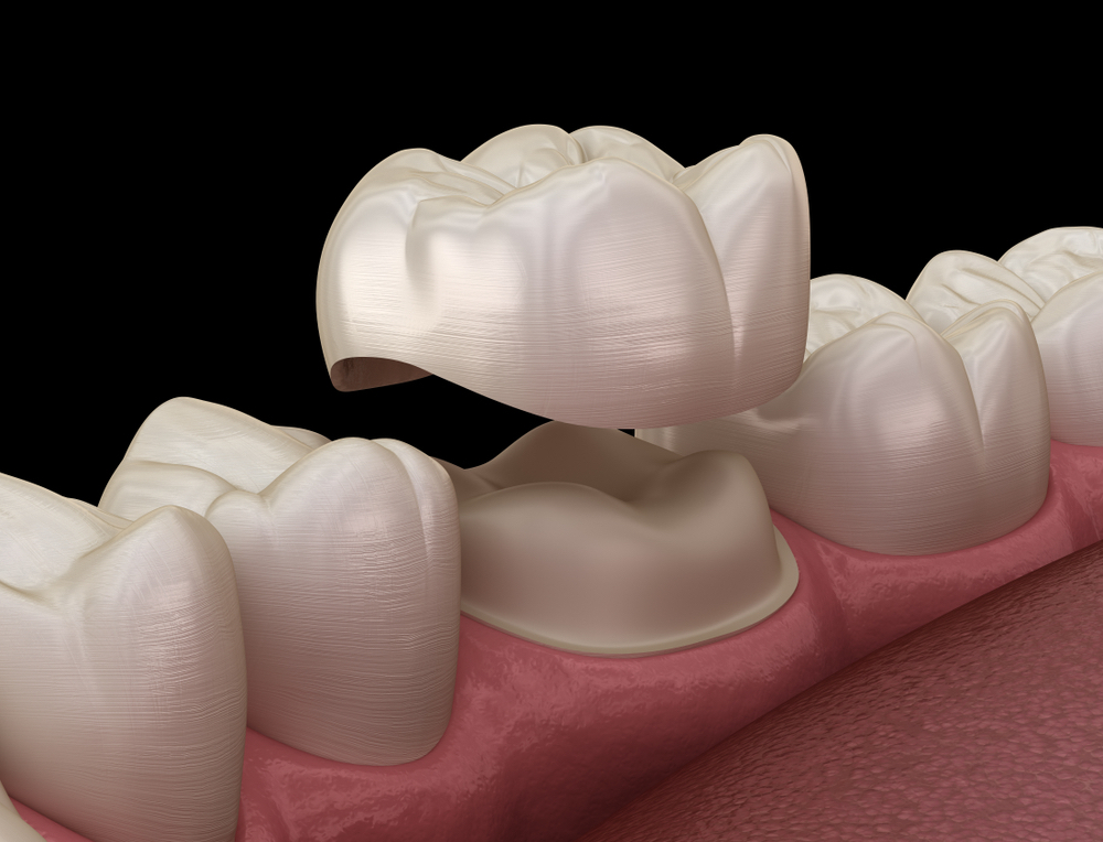 Different Types of Dental Crowns Available in Dubai - Dr Joy Dental Clinic