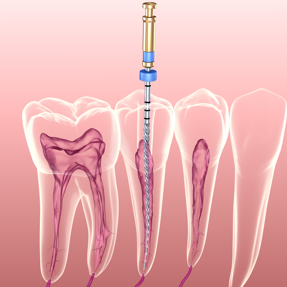 root canal in dubai