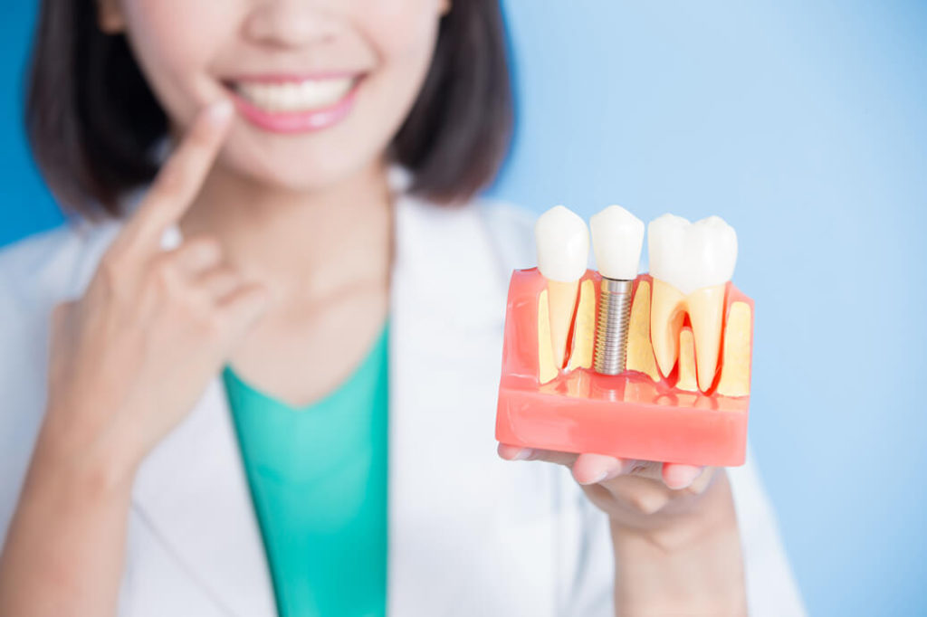 myth-about-dental-implants.jpg
