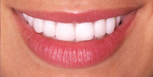 After Treatment Photo