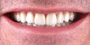 After Treatment Photo