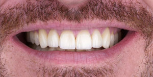 After Treatment Photo