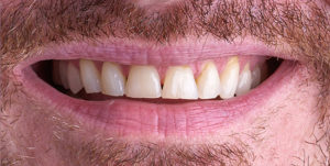 Before Treatment Photo