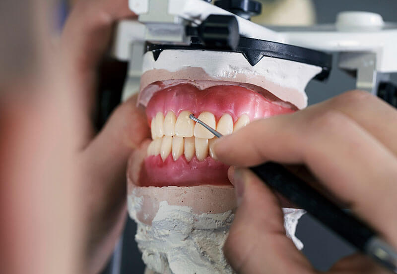 Digital-Smile-Design-or-Wax-Up