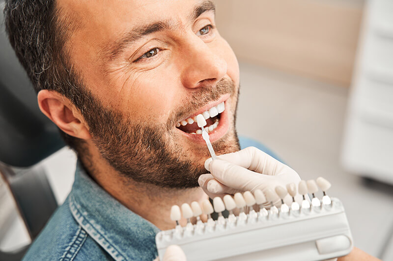 dental veneers