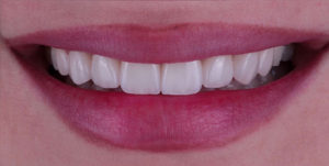 After Treatment Photo
