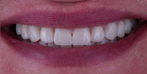 After Treatment Photo