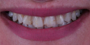 Before Treatment Photo