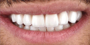After Treatment Photo