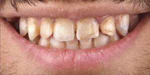 Before Treatment Photo