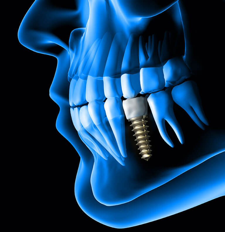 3d guided dental implants in dubai