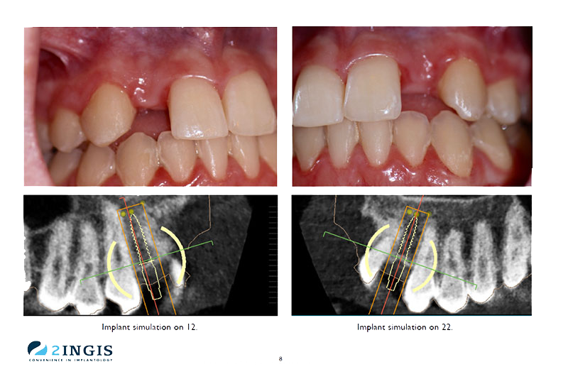 3d dental implants before and after