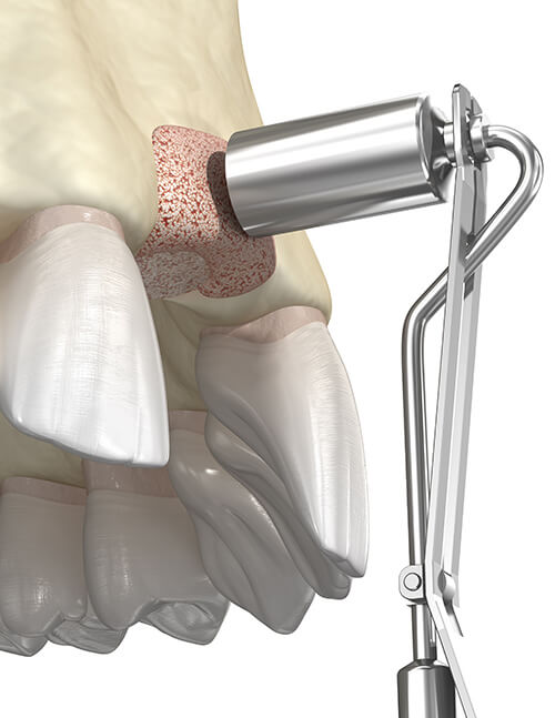 Bone-Grafting