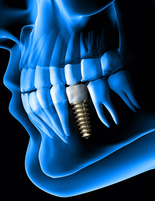 Dental-Implant--thumbnail