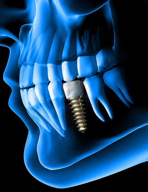 Dental-Implant--thumbnail