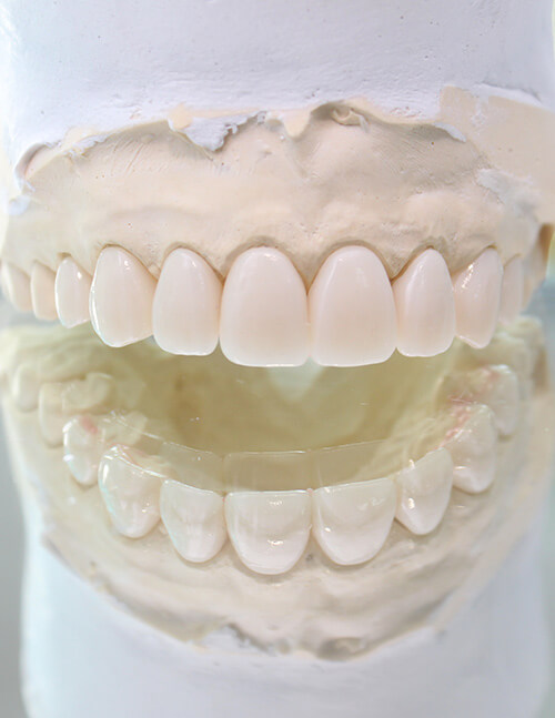 Full-Mouth-Dental-Implants