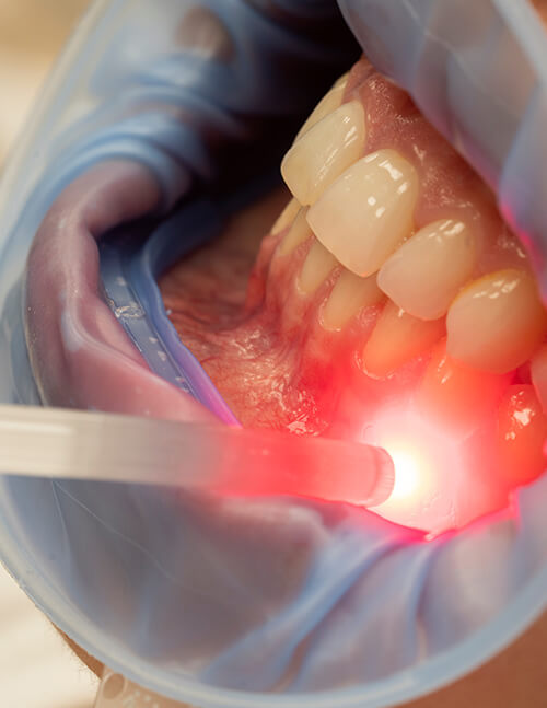Laser-Dentistry-for-Gum-Disease