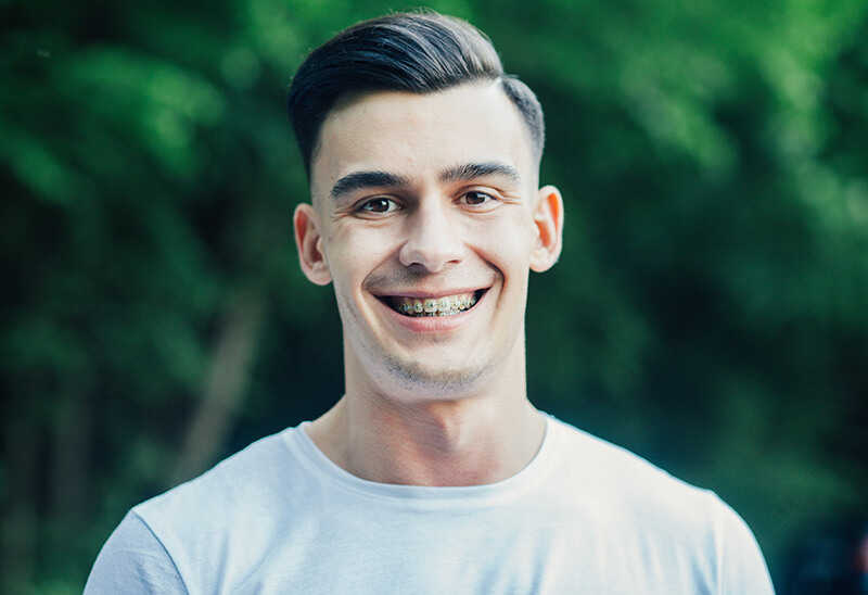 Metal-and-Ceramic-Braces