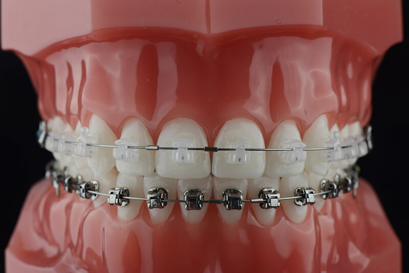 ceramic damon braces dubai