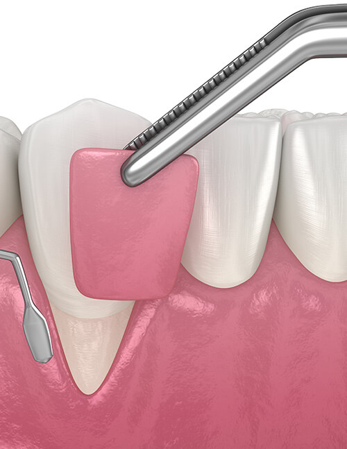 Pinhole-Gum-Rejuvenation