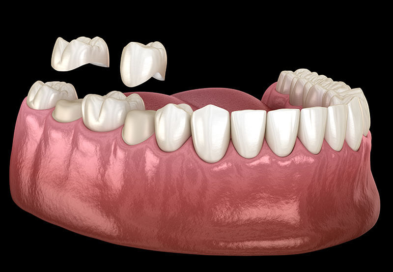 3d dental implant scan