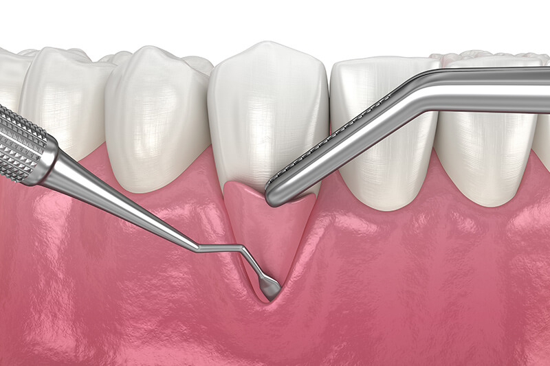 Receding-Gums-after (1)
