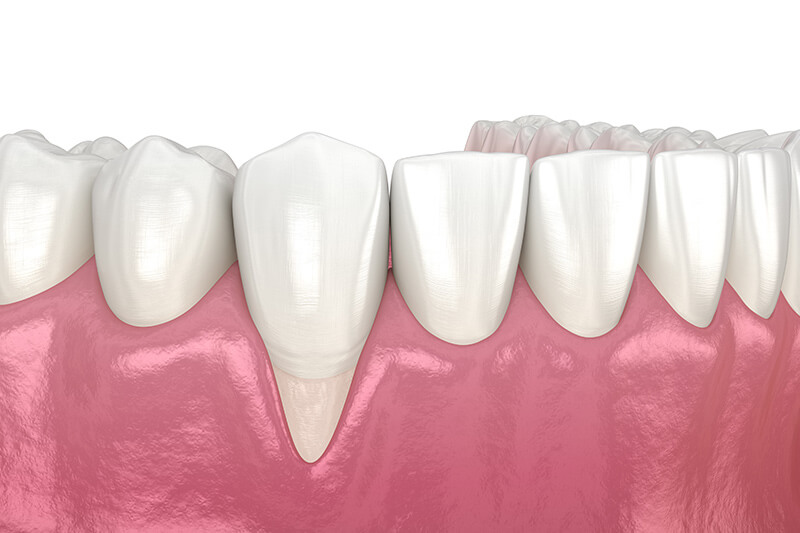 Receding-Gums-before