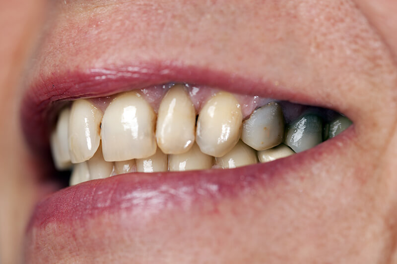 Symptoms-of-Tooth-Decay