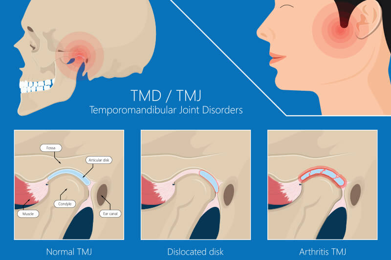 TMJ Treatment in dubai