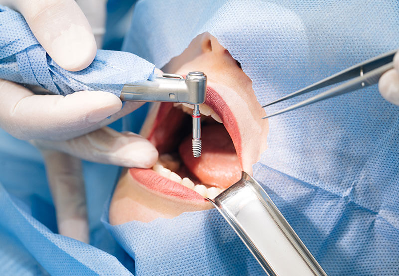 3d dental implants