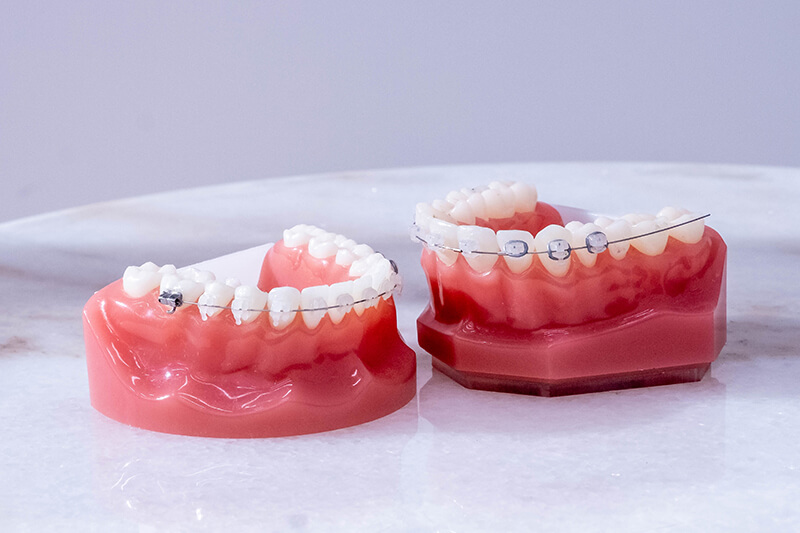 ceramic-braces-product