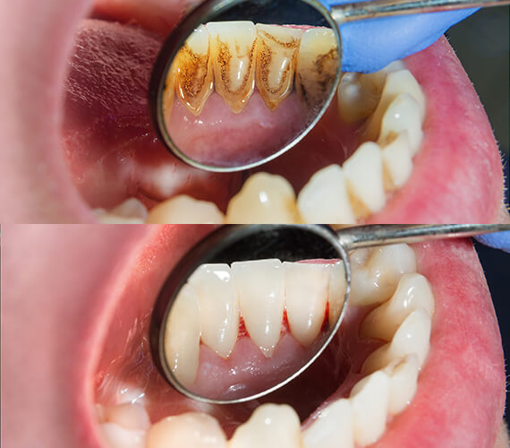Teeth cleaning near me