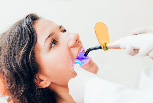 laser teeth whitening