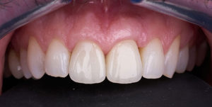 After Treatment Photo