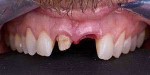 Before Treatment Photo