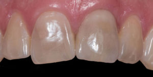After Treatment Photo