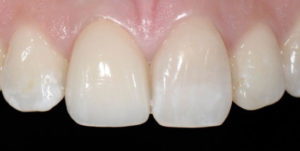 After Treatment Photo
