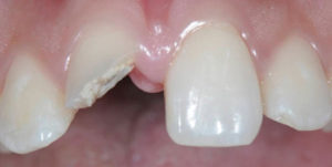 Before Treatment Photo