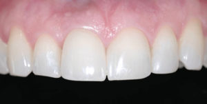 After Treatment Photo