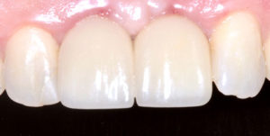 After Treatment Photo