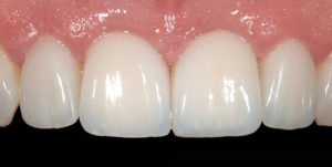 After Treatment Photo
