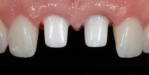 Before Treatment Photo