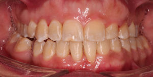 After Treatment Photo