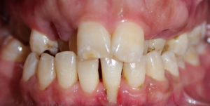 Before Treatment Photo